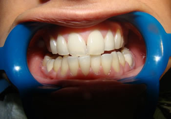 bleaching2