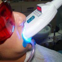 teeth whitening10