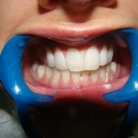 teeth whitening13