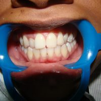 teeth whitening15