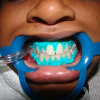 teeth whitening17