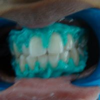 teeth whitening18