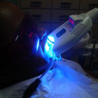 teeth whitening19