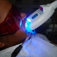 teeth whitening20