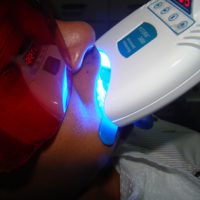 teeth whitening23