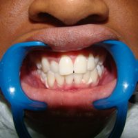 teeth whitening26