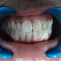 teeth whitening27