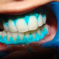 teeth whitening7