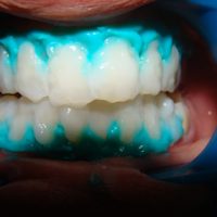 teeth whitening8