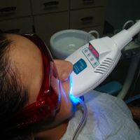 teeth whitening9